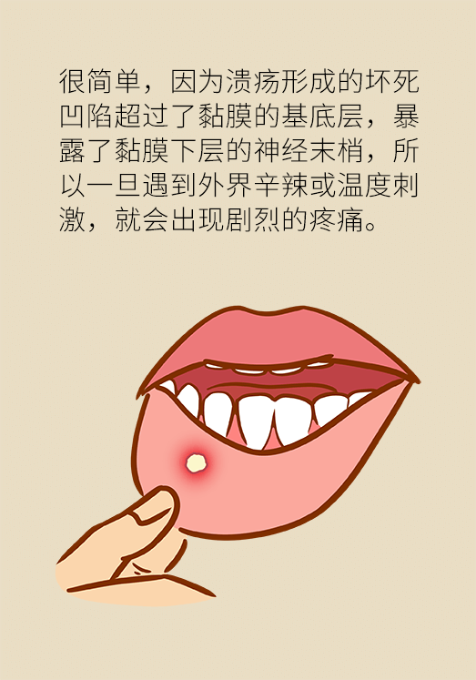 口腔溃疡怎样才能快速痊愈?试试这3种方法 - 小科普